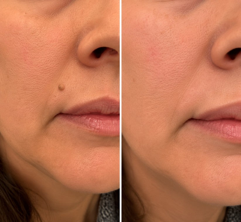 👩‍⚕️GFOUK® 2-in-1 Microneedle & Hydrocolloid Patch🍀 | Removes raised moles, acne, flat warts, and skin tags | Helps improve wrinkles, scars, and blemishes | Invisible patches for face and body.