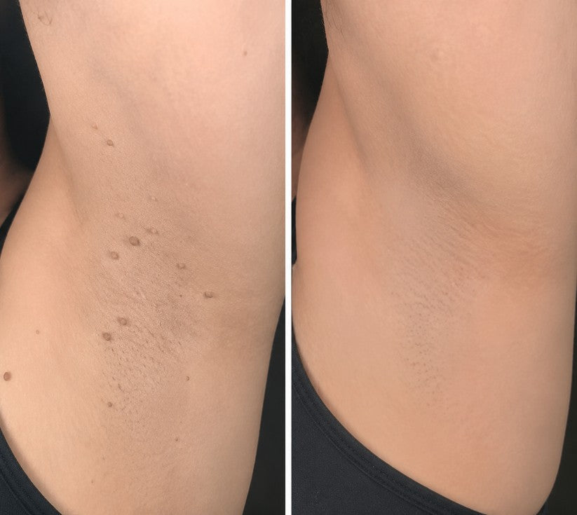 👩‍⚕️GFOUK® 2-in-1 Microneedle & Hydrocolloid Patch🍀 | Removes raised moles, acne, flat warts, and skin tags | Helps improve wrinkles, scars, and blemishes | Invisible patches for face and body.
